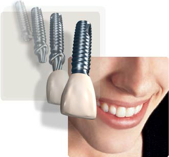dental_implants_cheaper