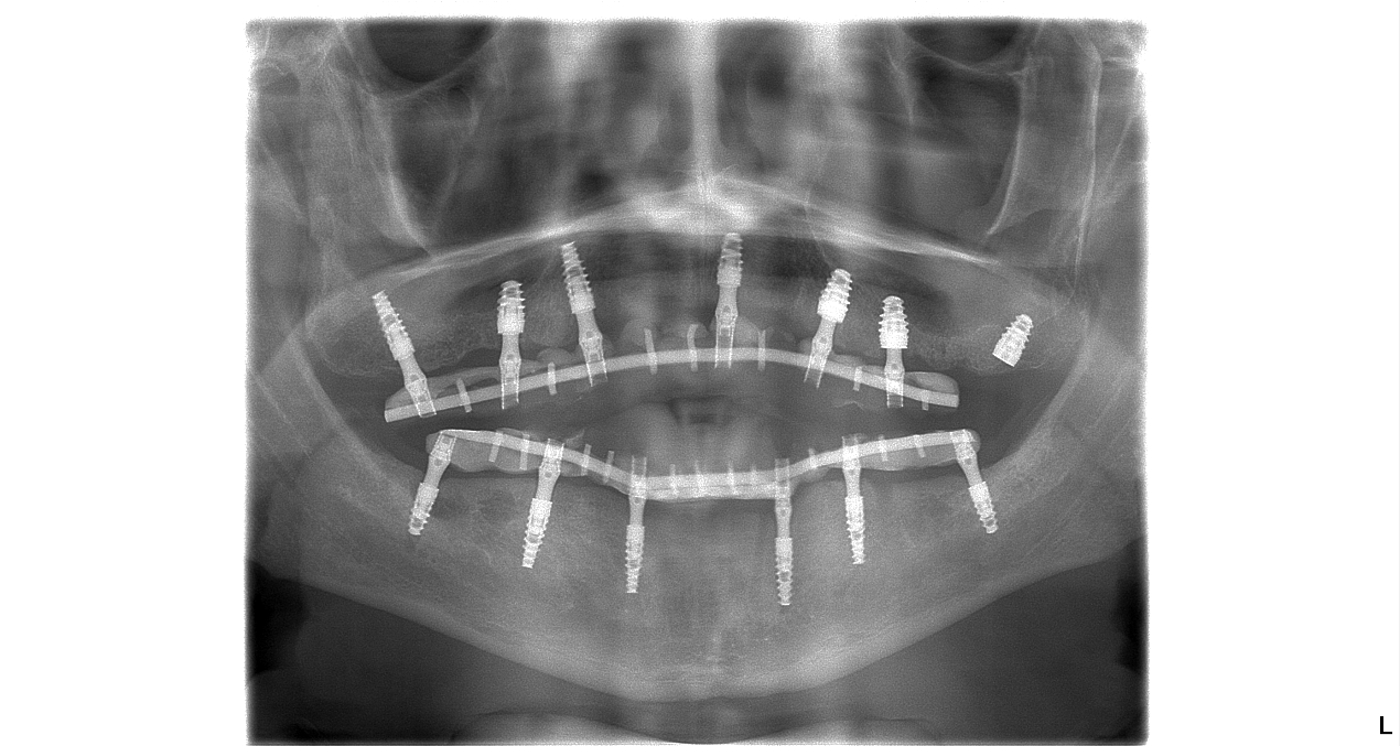 provizórna náhrada nasadená na zubných impalntátoch po ich zavedení